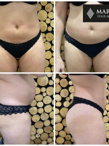 Trening EMS Trening EMS